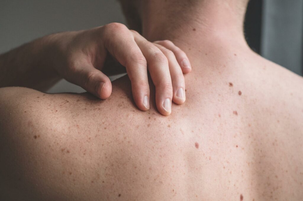 10 Minutes Can Save Your Life: Self-Skin Exams