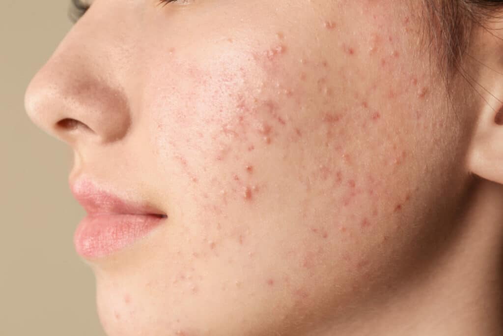 How Does a Facial for Acne-Prone Skin Differ From a Basic Facial?