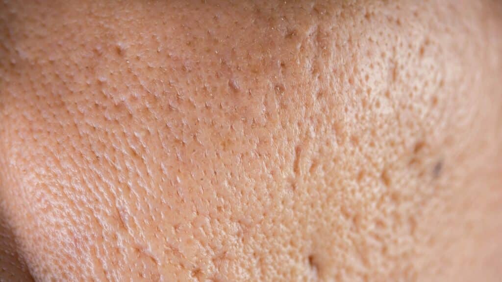 What Is the Best Treatment for Acne Scars?