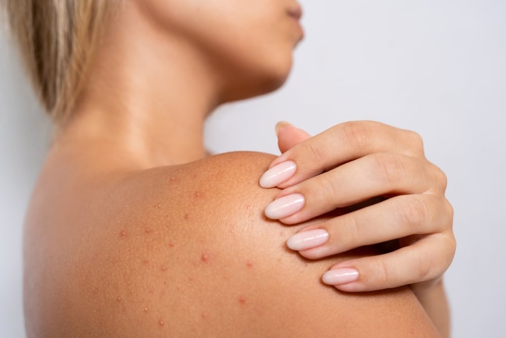 What Causes Bacne and How Do You Get Rid of It?